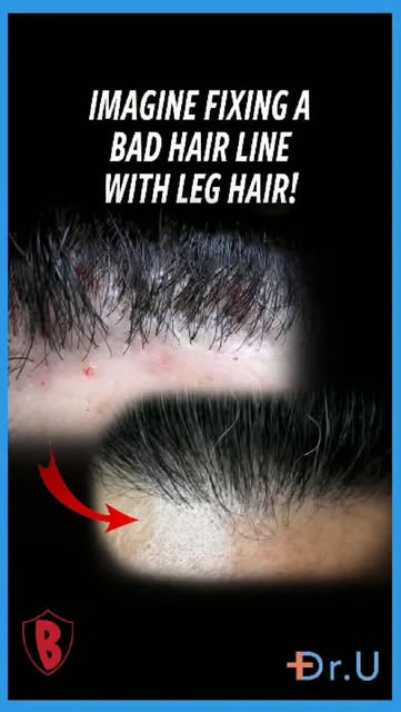 Leg hair to fix a hairline? Yes, it can be done.

This patient came in with a harsh, pluggy-looking 
