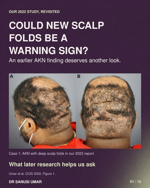 Could new scalp folds be a warning sign in someone with AKN?

In 2022, my colleagues and I reported 