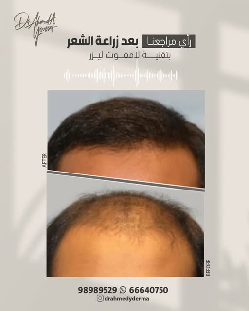 تجربة مراجعنا بعد زراعة الشعر تتكلم عن نفسها 👌🏻✨
من أول الاستشارة لي المتابعة بعد الإجراء… اهتمام 