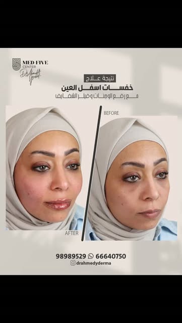 لمسات بسيطة… بس تفرق بملامحج كلها ✨

علاج خسفات تحت العين لمظهر أريح وأكثر نضارة، رفع وتحديد الوجنات