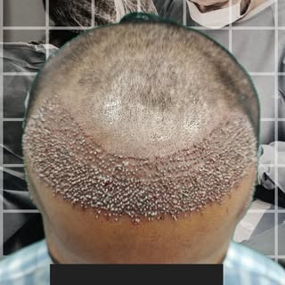 A new hairline. A new confidence. ✨
Natural-looking hair restoration is not just about adding grafts