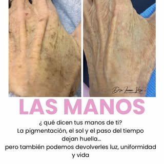 Manchas en las manos = envejecimiento visible.

El IPL es uno de los tratamientos más eficaces para: