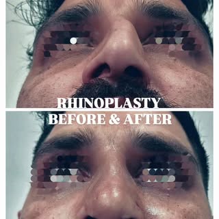 Rhinoplasty recovery is gradual — early swelling settles quickly, and results continue improving for