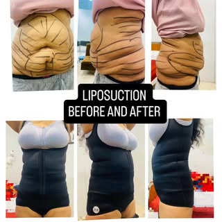 Liposuction isn’t just about looks — it’s about confidence, comfort, and a more sculpted you. #Lipos