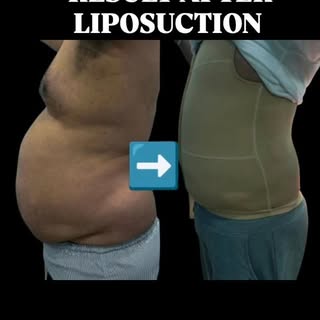 Liposuction isn’t just about looks — it’s about confidence, comfort, and a more sculpted you. #Lipos