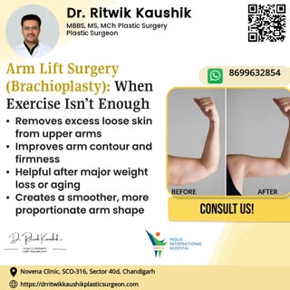 Loose arm skin can persist despite exercise. Arm lift surgery helps restore firmer, more contoured a
