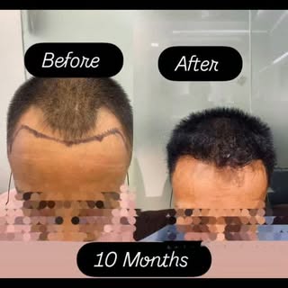 Hair restoration focuses on improving hair density and appearance through individualized treatment a