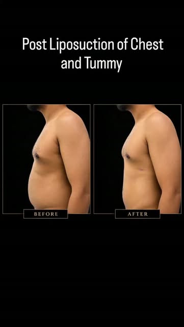With proper technique and post-op care, gynecomastia surgery delivers a flatter, masculine chest wit