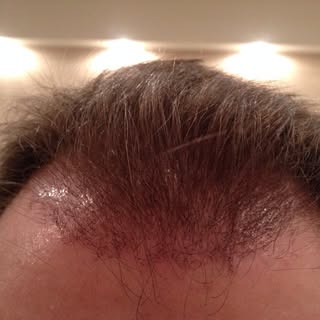 Patient 3458 grafts 1 months after fue operation