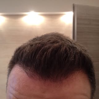 Patient 3458 grafts 5 months after fue operation