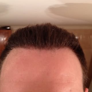Patient 3458 grafts 6 1/2 months after fue operation