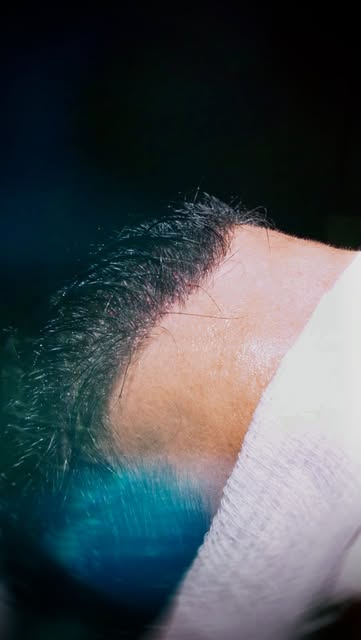 Transplante Capilar No-Shave, para quem busca recuperar os fios sem precisar raspar o cabelo. 

Uma 