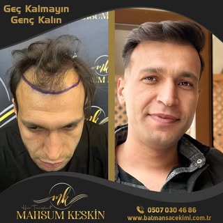 Fatih bey yeni saçları hayırlı olsun… 

ÖMÜR BOYU GARANTİLİ EKİM
➡️KESİN SONUÇ GARANTİSİ
➡️SINIRSIZ 