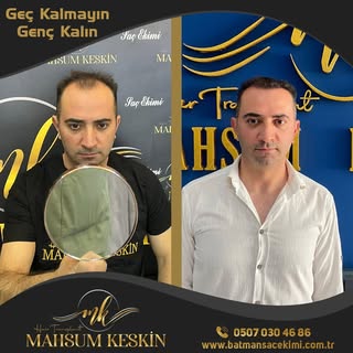 Hüseyin bey hayırlı olsun… 

ÖMÜR BOYU GARANTİLİ EKİM
➡️KESİN SONUÇ GARANTİSİ
➡️SINIRSIZ GREFT
DETAY