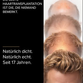 Haartransplantation Bemedics - Einheitliche Begriffe (Mini‑Glossar):

FUE: Entnahmeart: Follicular U
