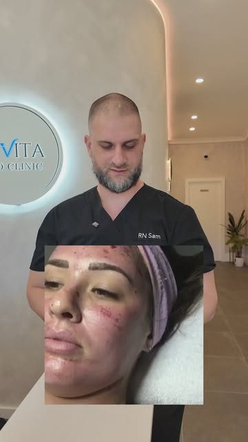This is not normal! Come see a registered nurse for any needling needs

#skinneedling #clinic #react