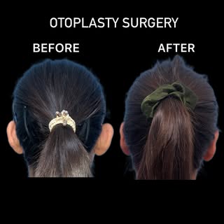 “OTOPLASTY SURGERY For BAT EAR Prominent Ear /Bat Ear Correction To Improve the Personality & Boost 