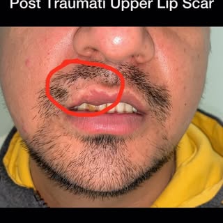 “Scar Hair Transplant is a Procedure that places Healthy Hair follicles in to scar Tissue. It is Oft