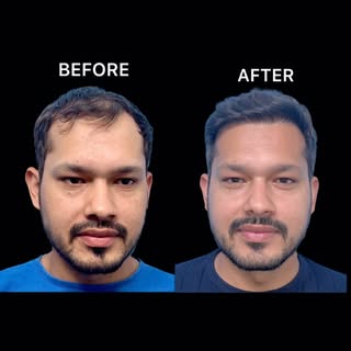 “FUE Hair TRANSPLAT JOURNEY WITH Dr. HARISH GHILDIYAL & TEAM at MEDICRAFT CLINIC DEHRADUN.! For more