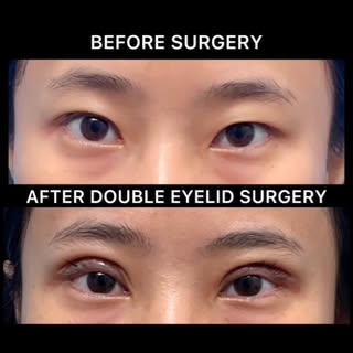 Asian double eyelid surgery, or Asian blepharoplasty, is a cosmetic procedure that creates a defined