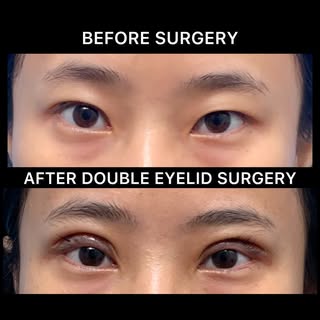 Double Eyelid Surgery (BLEPHAROPLASTY) it is a Daycare Surgery!
For more information please contact 