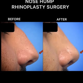 Dorsal Hump Reduction is a Plastic Surgery to Remove to Nose Hump. 
This Highly Precious Surgery Per