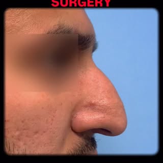 “Dorsal Hump Reduction is a Plastic Surgery to Remove Nose Hump. This Highly Precious Surgery Perman