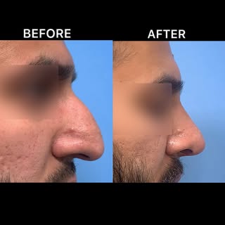 Rhinoplasty Surgery-Shape Your Nose, Enhance Your Confidence.”
Advanced Rhinoplasty Surgery by Dr. H