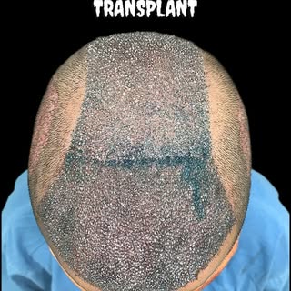 “Hair Transplant with Natural Hairline & Best Density at Medicraft Clinic By Plastic Surgeon Dr. Har