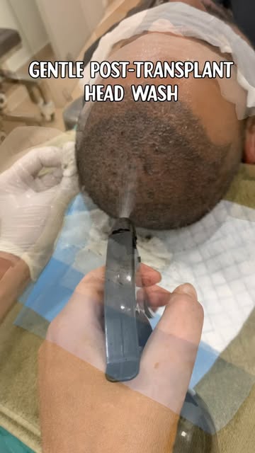 An FUE (Follicular Unit Extraction) hair transplant is a surgical procedure where individual hair fo