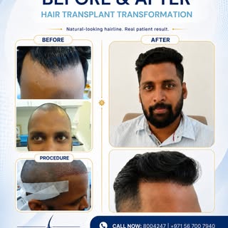 Hair Transplant Transformation at Al Borj Hair Clinic ✨

A natural-looking hairline can make a big d