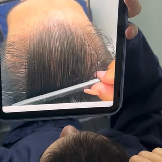 #tricologia #terapiacapilarintegrativa #alopécia #alopeciaandrogenetica