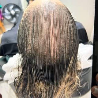 Finalizando mais um protocolo com o coração alegre e cheio de gratidão! 
Que resultado incrível em a