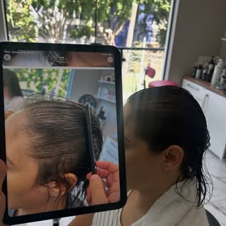 Evolução no tratamento da alopecia androgenética feminina!

Já conseguimos observar melhora na cober