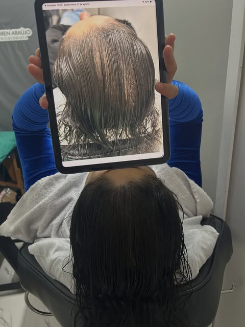 Resultado de 4 meses de tratamento para alopecia androgenética, com evolução visível na densidade ca