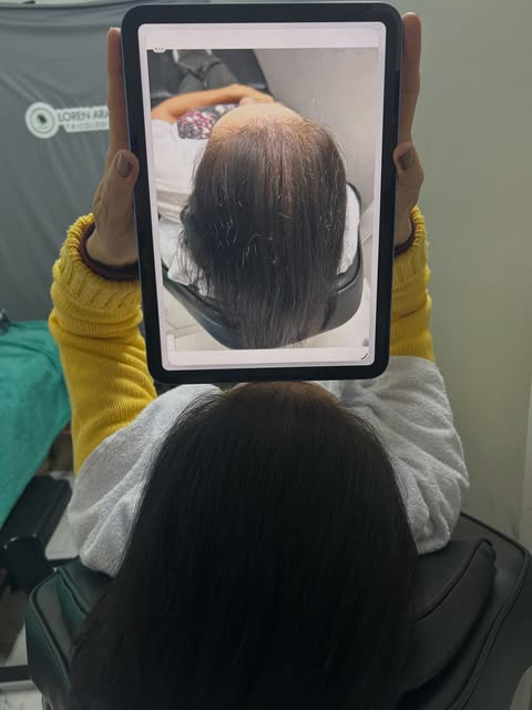 Paciente com Alopecia Androgenética associado a Eflúvio Telogeno tratamento iniciado 07/07/26 finali