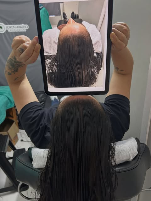 ANTES E DEPOIS | Alopecia Androgenética Feminina

Resultado após 3 meses de tratamento

Nesse períod
