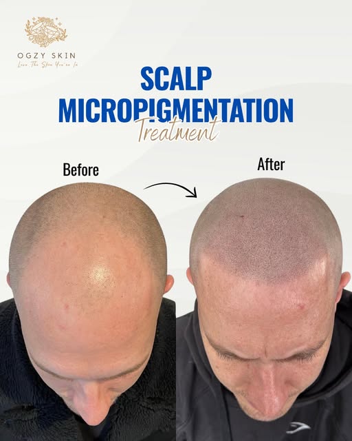Reclaim your hairline and your confidence without invasive surgery.

At Ogzy Skin, my Scalp Micropig