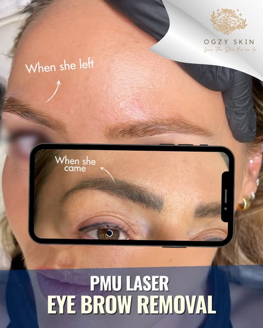 Hitting the reset button on your brows requires absolute precision.

Removing pigment from the delic