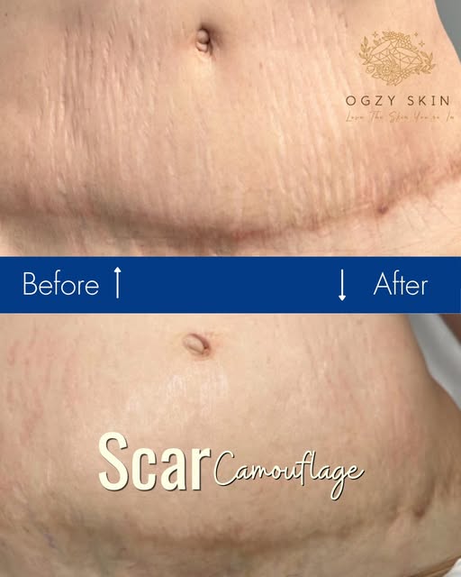 Your surgical journey isn't truly complete until you feel flawless in your skin.

Scars from abdomin
