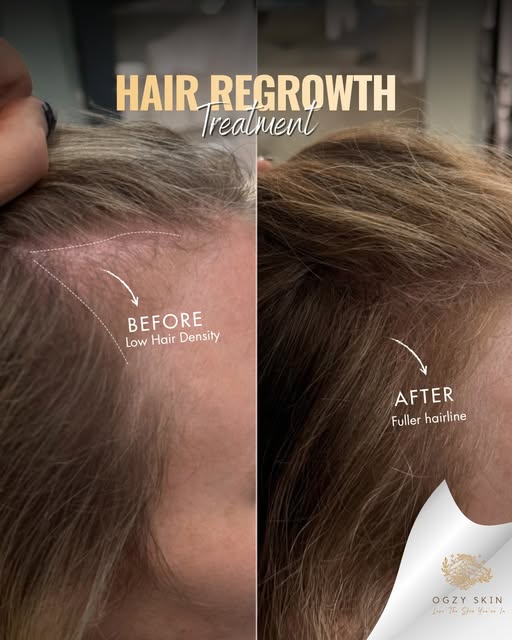 Stop relying on temporary styling tricks and powders to hide low hair density.

Real, structural hai