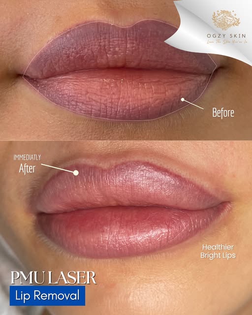 If your lip blush has healed into a dark, unnatural tone, you don't have to live with it.

At Ogzy S