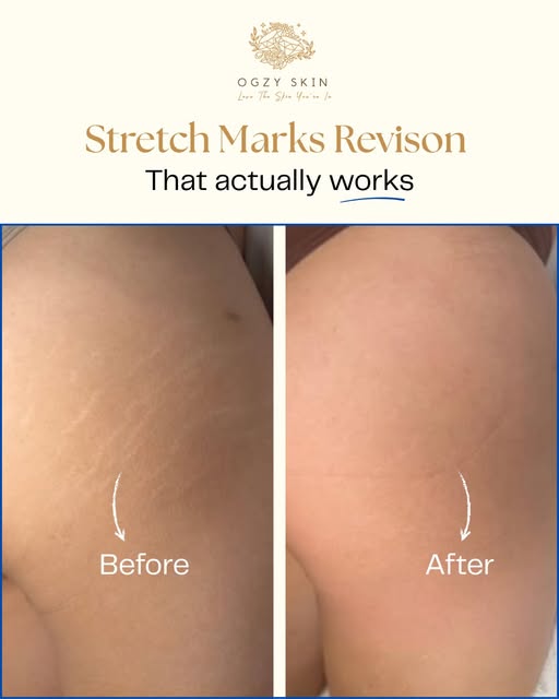 You don't have to live with the harsh contrast and deep texture of stubborn stretch marks.

Through 