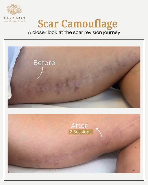 Healing is a journey, and true skin revision requires a high-end, structural solution.

Severe, hype