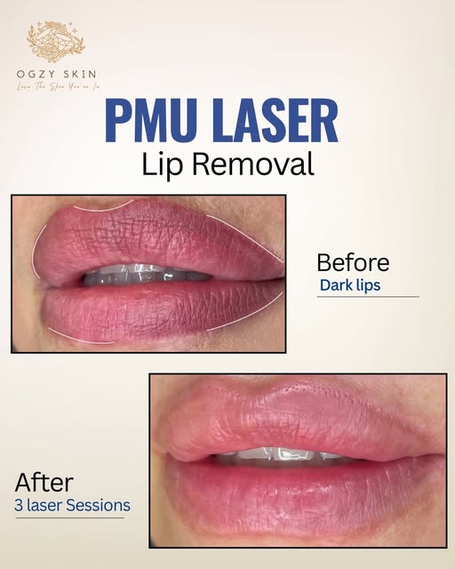 A botched or overly dark lip blush does not have to be a permanent mistake.

Safely lifting dark, co
