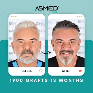 🇬🇧13 months ago, I underwent a hair transplant operation involving 1900 grafts at my own clinic, w