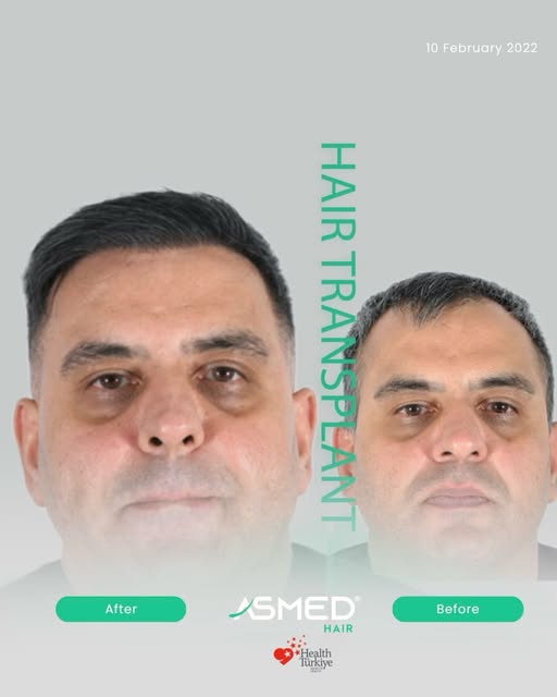 5018 Grafts – 13 Months
There is no single standard for hair transplantation. Each procedure is plan