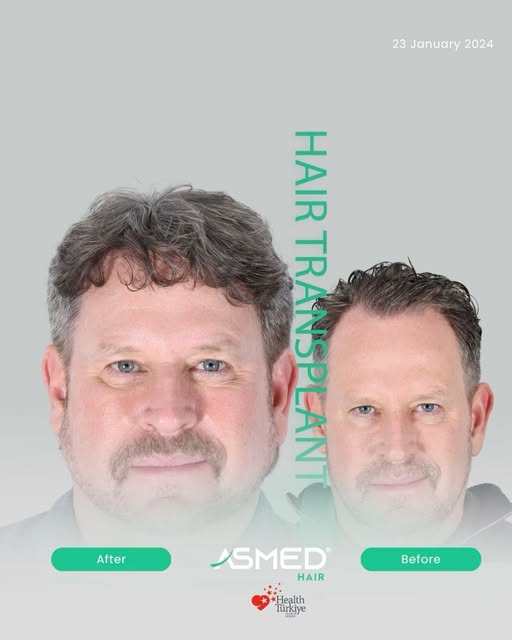 1 Year 8 Months
Hair characteristics, existing density and individual needs are considered throughou