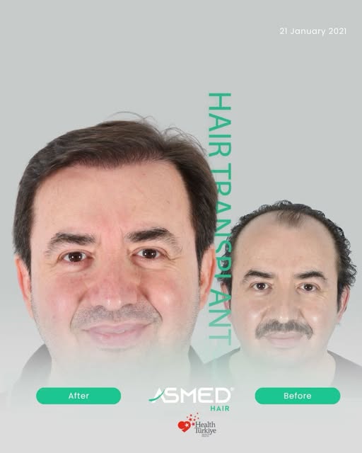 5060 Grafts 4.5-Year Result
From planning to placement, each stage of the procedure is carried out w