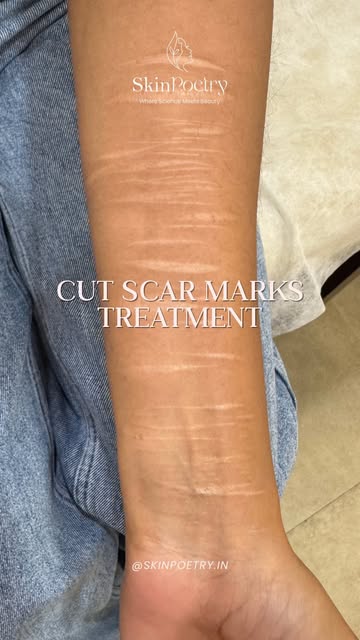Treating cut scars is not about “erasing” the scar — it’s about improving the way the scarred skin l